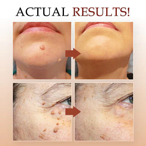 LOVILDS™ Tags & Moles Remover| Buy 1 Get 1 Free🔥🔥